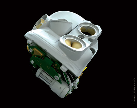 The artificial heart produced by Carmat (Photo courtesy Carmat. All rights reserved)