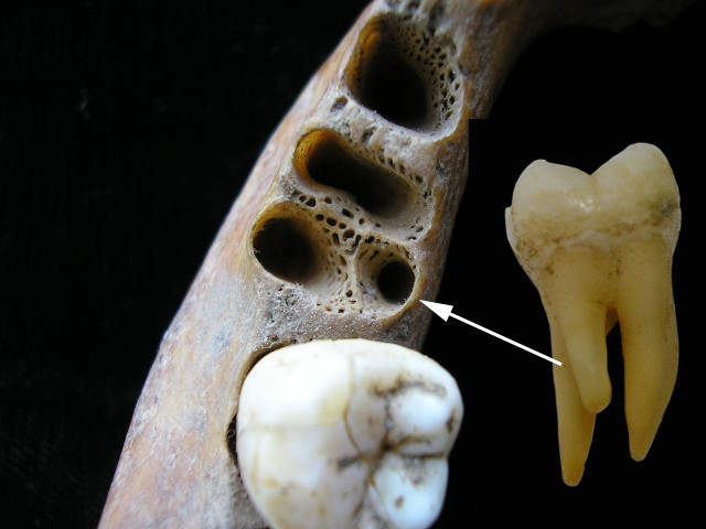 Tooth socket for a three-rooted molar (Image courtesy Christine Lee. All rights reserved)